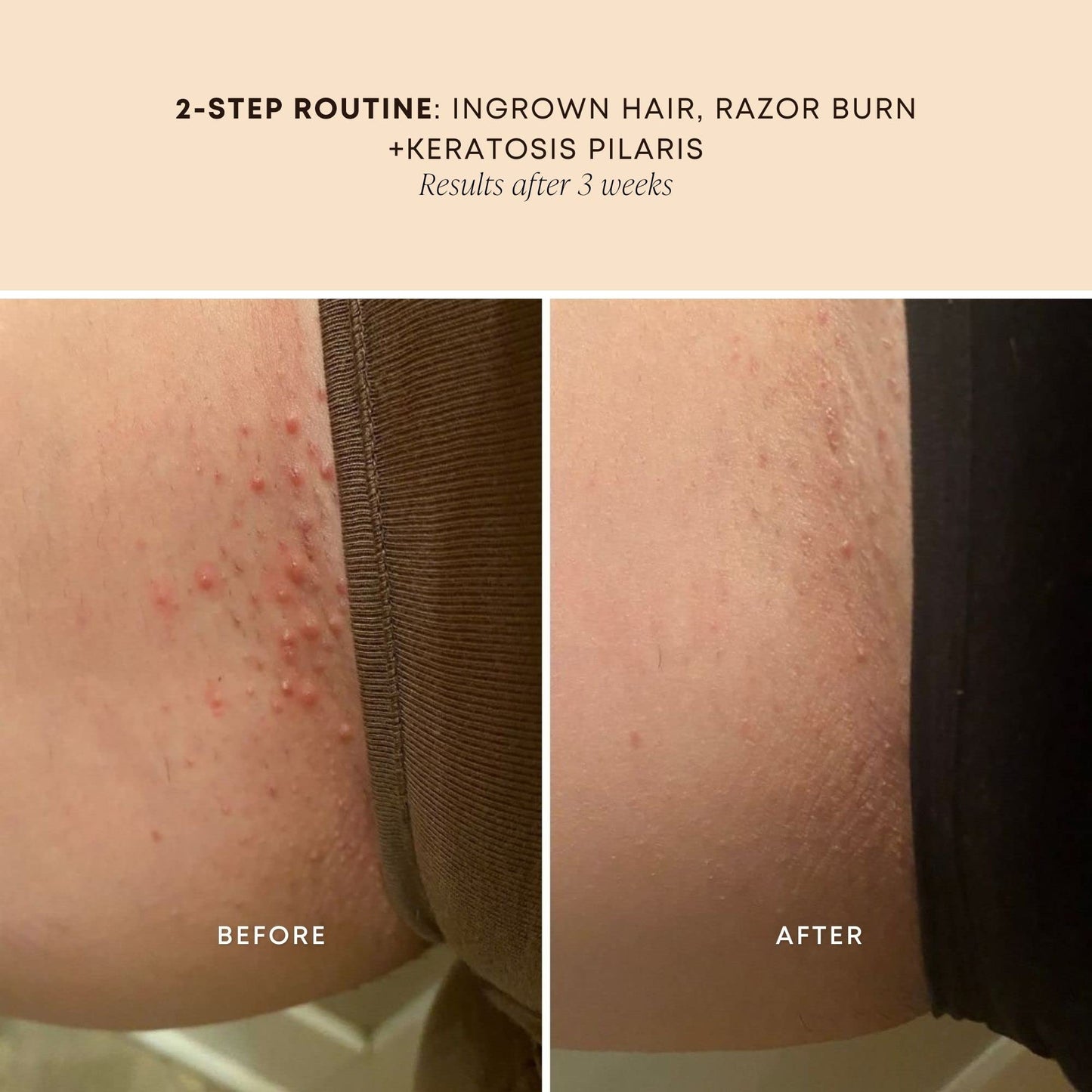 BushBalm Scented Ingrown Treatment Oil - Sweet Escape